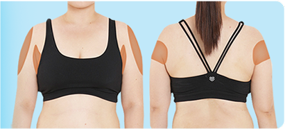 Photo showing thick arms slimming down after V-Logic Body PT injection