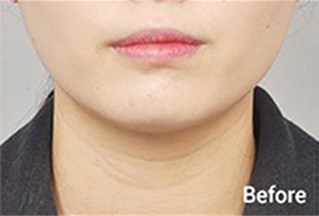 Before-and-after photo of V-line results after Contour Tox 4 types treatment