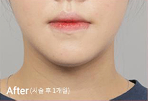 Before-and-after photo of V-line results after Contour Tox 4 types treatment