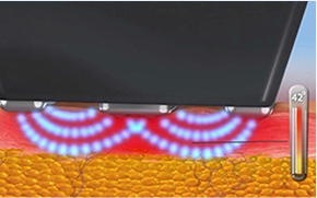 Image showing the effects of InMode FORMA mode on skin layers