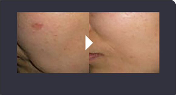 Smooth skin texture improvement comparison image before and 4 weeks after Rejuran Healer treatment