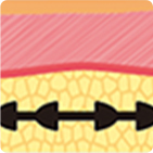 Evolution of thread lifting structure from 1st to 4th generation