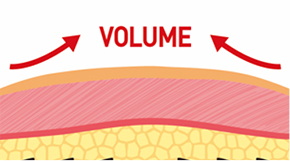 Explanation of how Silhouette Soft avoids nerve stimulation with movable cones