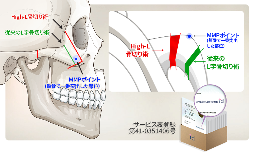 id頬骨最大縮小術の骨切りの位置
