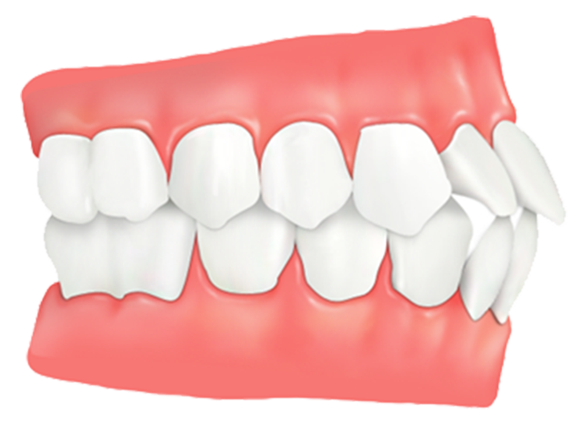 id-セットバック-歯が原因の場合