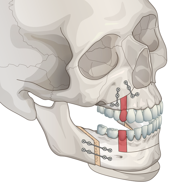 id-突き出し口三顎手術-三顎手術