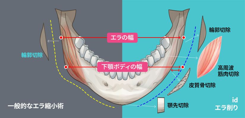 id-メンズ輪郭整形-エラ削り