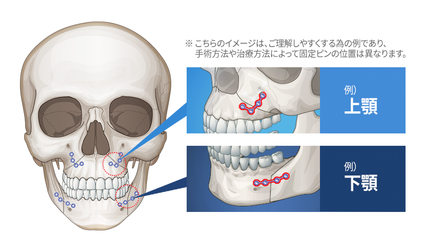 両顎固定ピン除去の時、固定ピンの位置