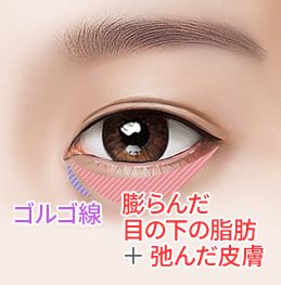 id-若返り眼下脂肪再配置-皮膚が伸び弛みがひどい場合に行う