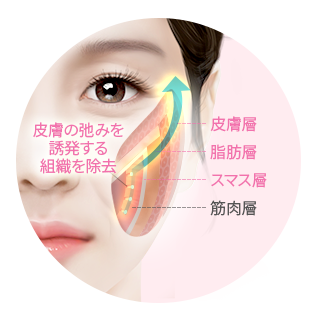 id-ほうれい線 スマスリフト-ほうれい線スマスリフト