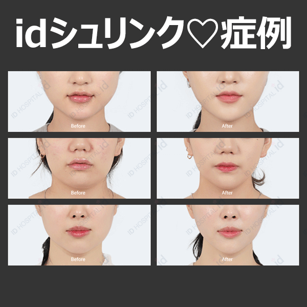 韓国在住者限定 嬉しいプチ整形 皮膚科メニューの最大割引きイベント 韓国 Id美容外科