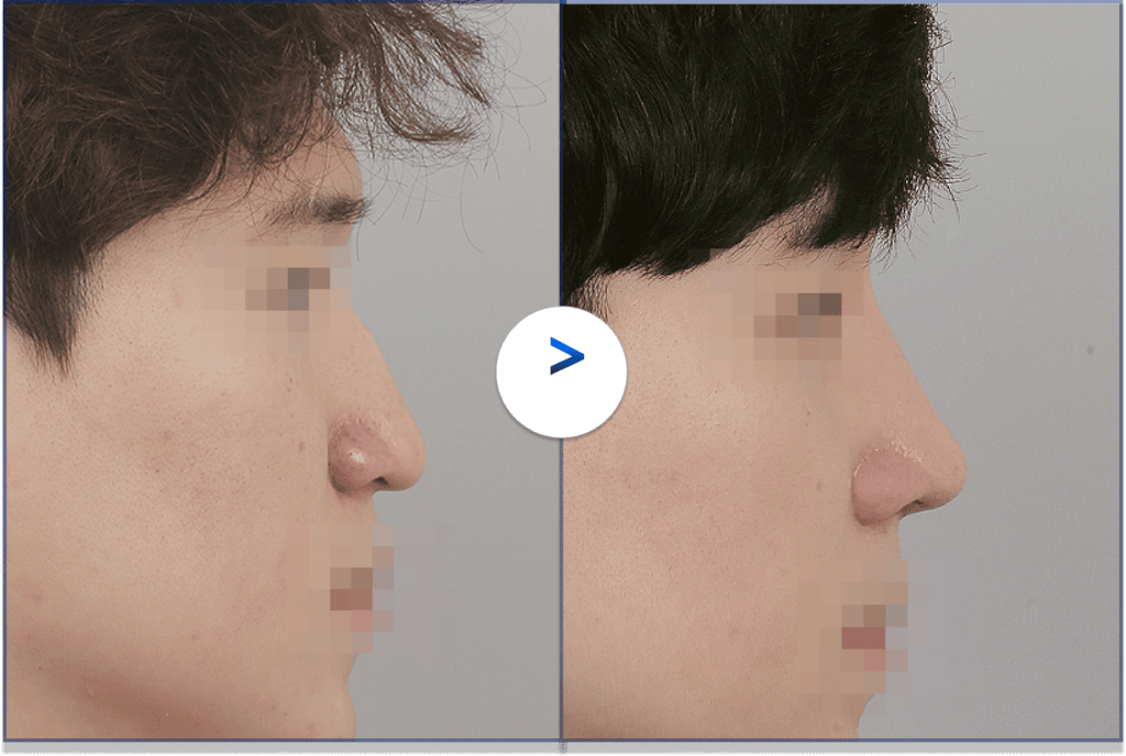 美人の新基準、忘れ鼻とはどんな鼻のこと？ - 【韓国 id美容外科】