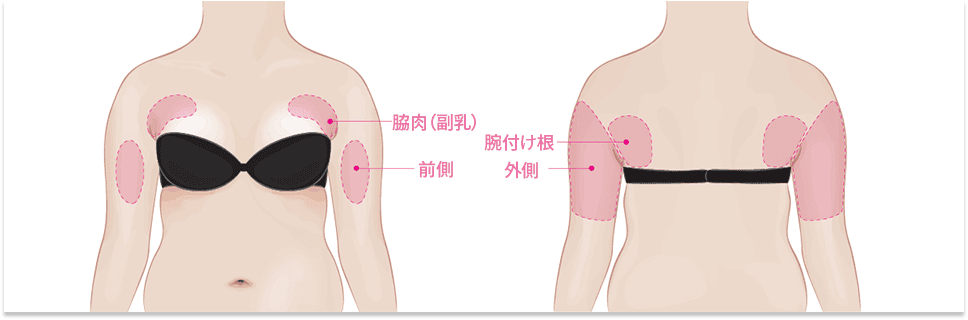 腕_ライン整形