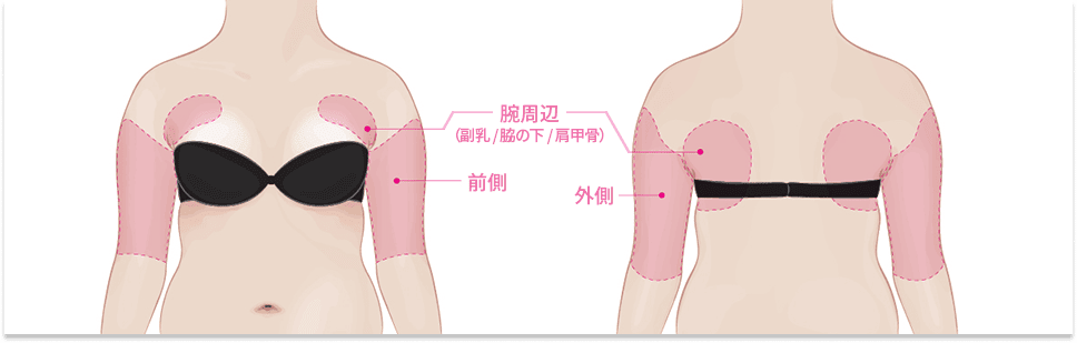 腕_ライン整形