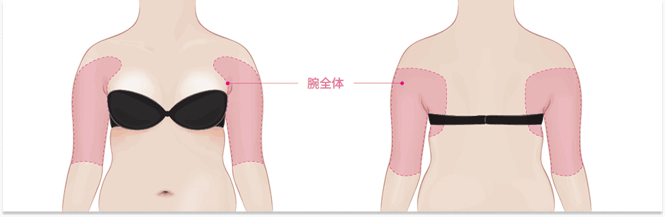 腕_ライン整形