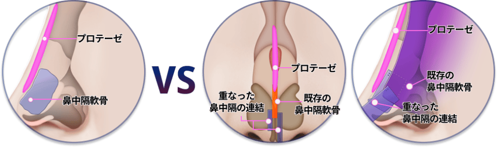 ステージシリアルエクステンションテクニック