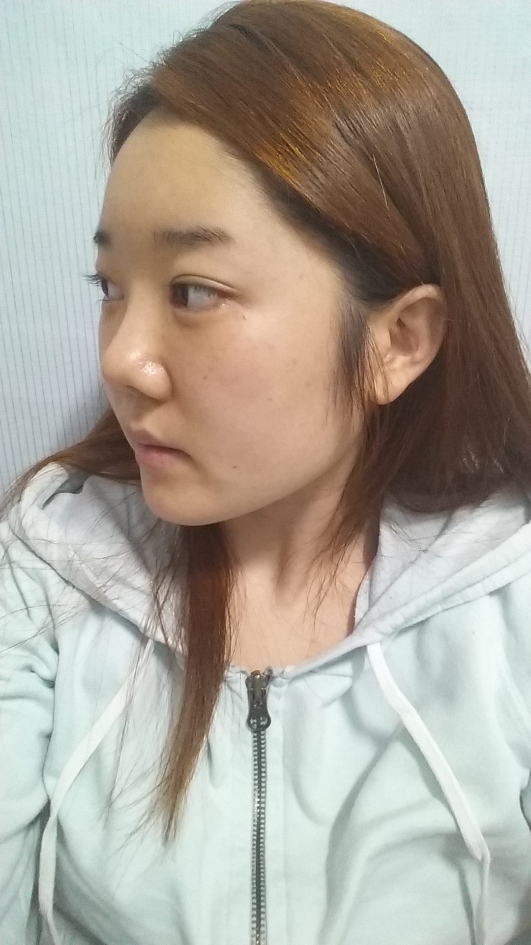 Vライン形成＋鼻手術をされた女性のリアルセルフィーをご紹介：韓国整形サポート 韓国整形無料サポートナビコリア